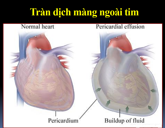 Tràn dịch màng ngoài tim